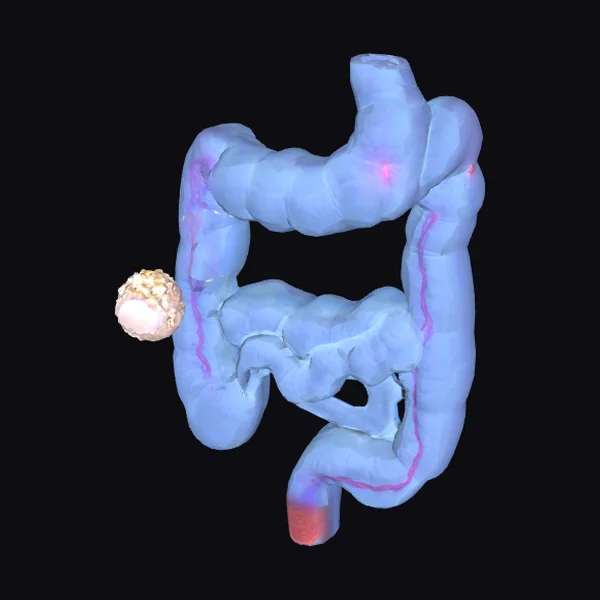 Dissolving Pill in Colon